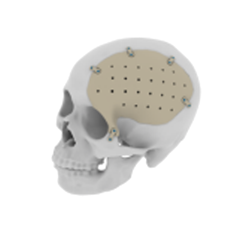 PEEK skull repair system